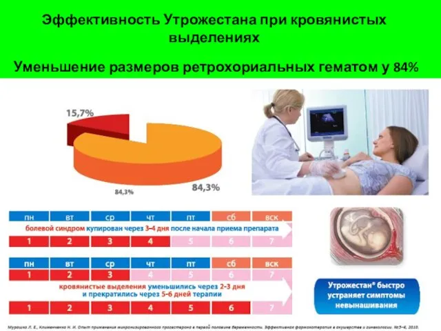 Эффективность Утрожестана при кровянистых выделениях Уменьшение размеров ретрохориальных гематом у 84%