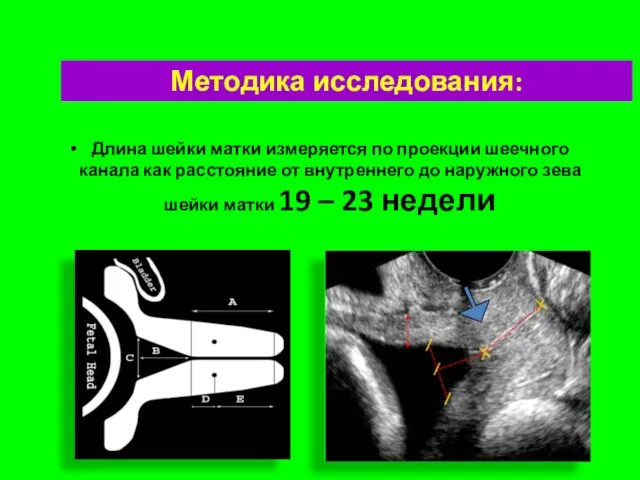 Методика исследования: Длина шейки матки измеряется по проекции шеечного канала как