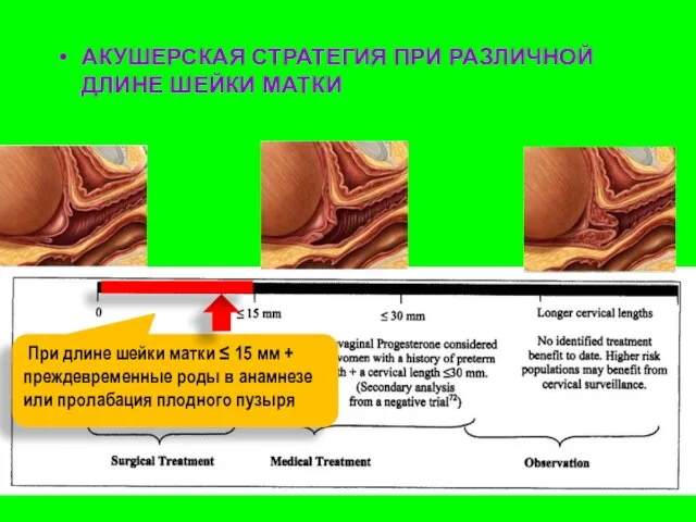 АКУШЕРСКАЯ СТРАТЕГИЯ ПРИ РАЗЛИЧНОЙ ДЛИНЕ ШЕЙКИ МАТКИ При длине шейки матки