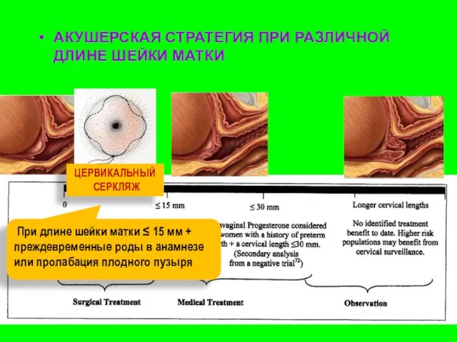 АКУШЕРСКАЯ СТРАТЕГИЯ ПРИ РАЗЛИЧНОЙ ДЛИНЕ ШЕЙКИ МАТКИ ЦЕРВИКАЛЬНЫЙ СЕРКЛЯЖ При длине