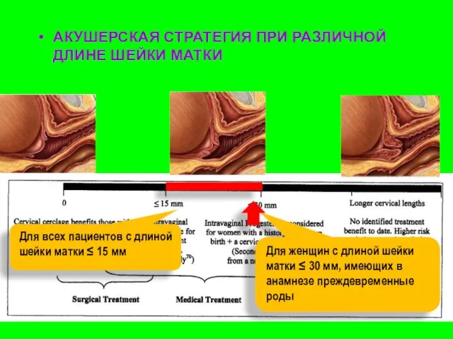 АКУШЕРСКАЯ СТРАТЕГИЯ ПРИ РАЗЛИЧНОЙ ДЛИНЕ ШЕЙКИ МАТКИ Для всех пациентов с