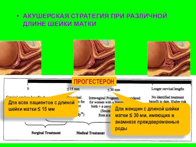 АКУШЕРСКАЯ СТРАТЕГИЯ ПРИ РАЗЛИЧНОЙ ДЛИНЕ ШЕЙКИ МАТКИ ПРОГЕСТЕРОН Для всех пациентов