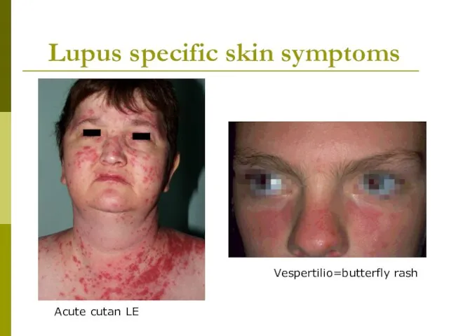 Lupus specific skin symptoms Vespertilio=butterfly rash Acute cutan LE