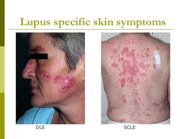 Lupus specific skin symptoms DLE SCLE