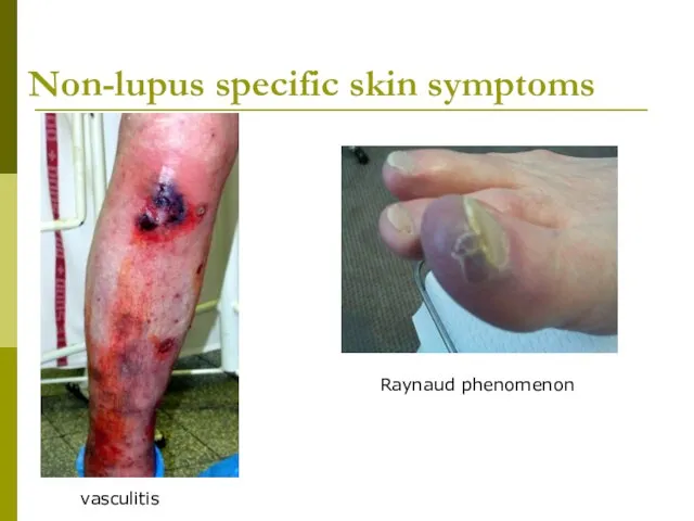 Non-lupus specific skin symptoms vasculitis Raynaud phenomenon