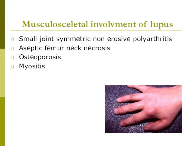 Musculosceletal involvment of lupus Small joint symmetric non erosive polyarthritis Aseptic femur neck necrosis Osteoporosis Myositis