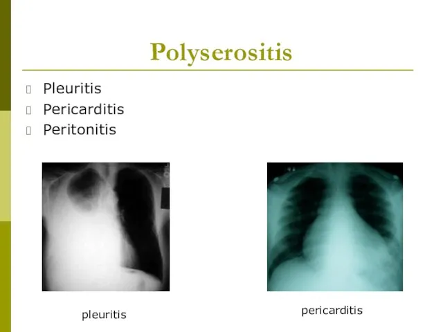 Polyserositis Pleuritis Pericarditis Peritonitis pleuritis pericarditis