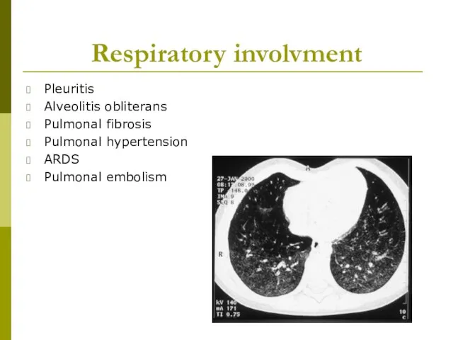 Respiratory involvment Pleuritis Alveolitis obliterans Pulmonal fibrosis Pulmonal hypertension ARDS Pulmonal embolism