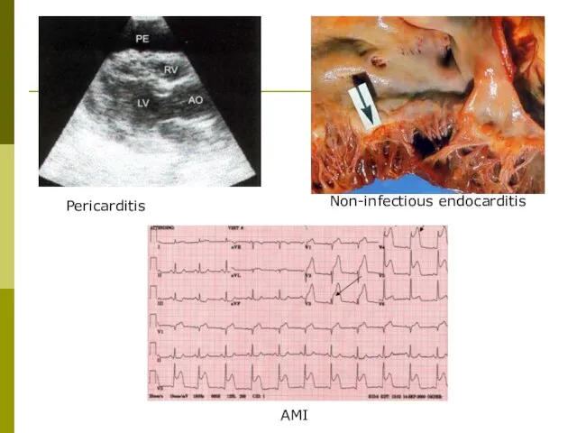 Pericarditis AMI Non-infectious endocarditis