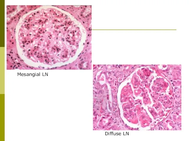 Mesangial LN Diffuse LN