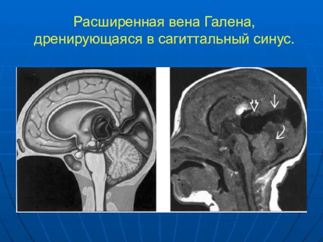 Расширенная вена Галена, дренирующаяся в сагиттальный синус.