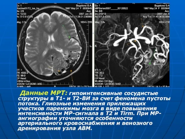 Данные МРТ: гипоинтенсивные сосудистые структуры в Т1- и Т2-ВИ за счет