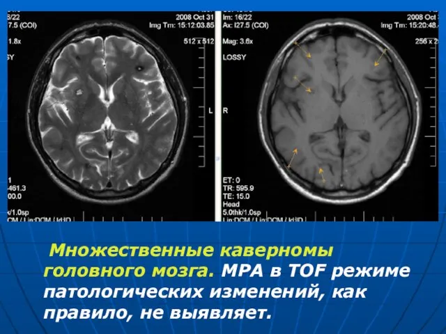 Множественные каверномы головного мозга. МРА в TOF режиме патологических изменений, как правило, не выявляет.