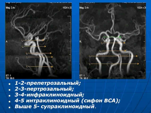 1-2-препетрозальный; 2-3-пертрозальный; 3-4-инфраклиноидный; 4-5 интраклиноидный (сифон ВСА); Выше 5- супраклиноидный.