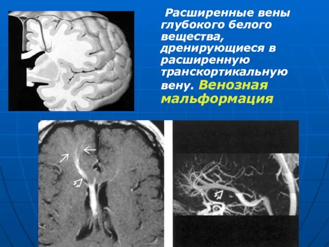 Расширенные вены глубокого белого вещества, дренирующиеся в расширенную транскортикальную вену. Венозная мальформация