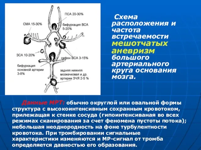 Схема расположения и частота встречаемости мешотчатых аневризм большого артериального круга основания