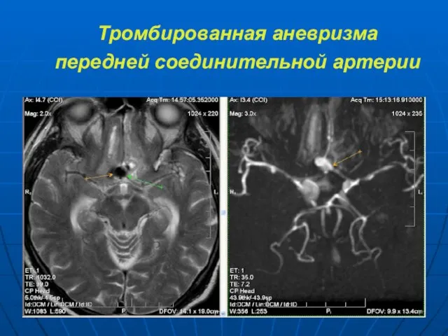 Тромбированная аневризма передней соединительной артерии