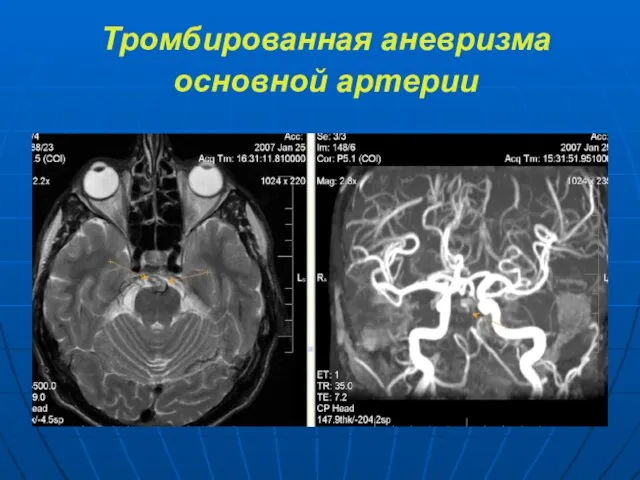 Тромбированная аневризма основной артерии