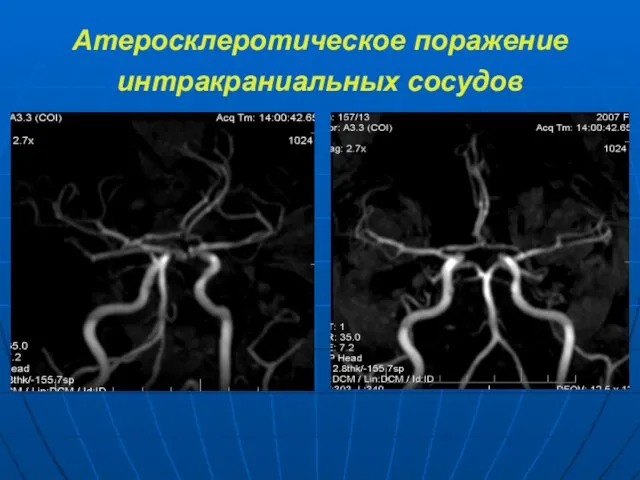 Атеросклеротическое поражение интракраниальных сосудов