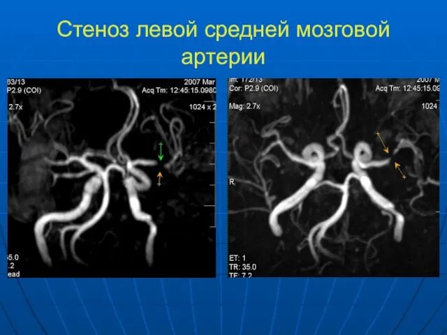 Стеноз левой средней мозговой артерии