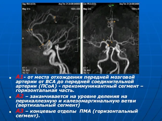 А1- от места отхождения передней мозговой артерии от ВСА до передней