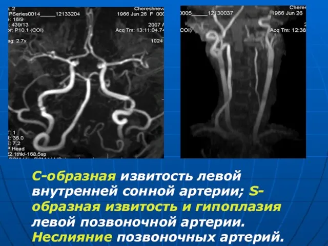 С-образная извитость левой внутренней сонной артерии; S-образная извитость и гипоплазия левой позвоночной артерии. Неслияние позвоночных артерий.