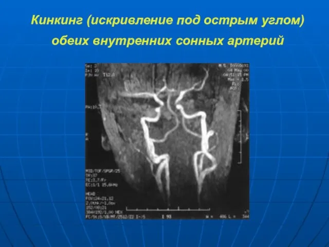 Кинкинг (искривление под острым углом) обеих внутренних сонных артерий