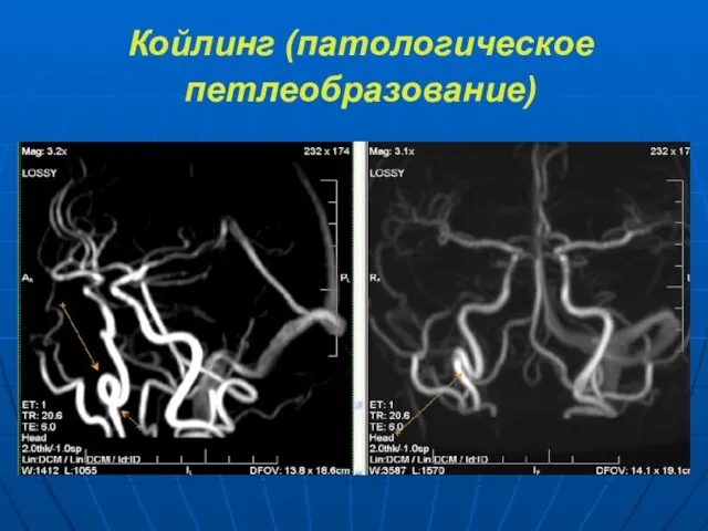 Койлинг (патологическое петлеобразование)