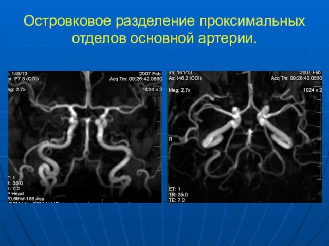 Островковое разделение проксимальных отделов основной артерии.