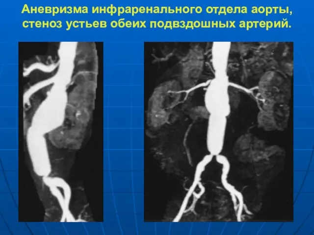 Аневризма инфраренального отдела аорты, стеноз устьев обеих подвздошных артерий.