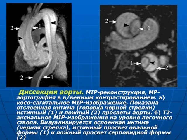 Диссекция аорты. МIP-реконструкция, МР-аортография в в/венным контрастированием. а) косо-сагитальное MIP-изображение. Показана