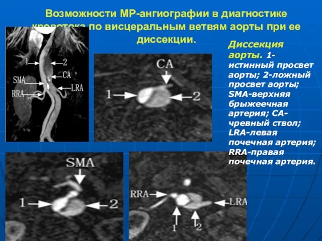 Возможности МР-ангиографии в диагностике кровотока по висцеральным ветвям аорты при ее