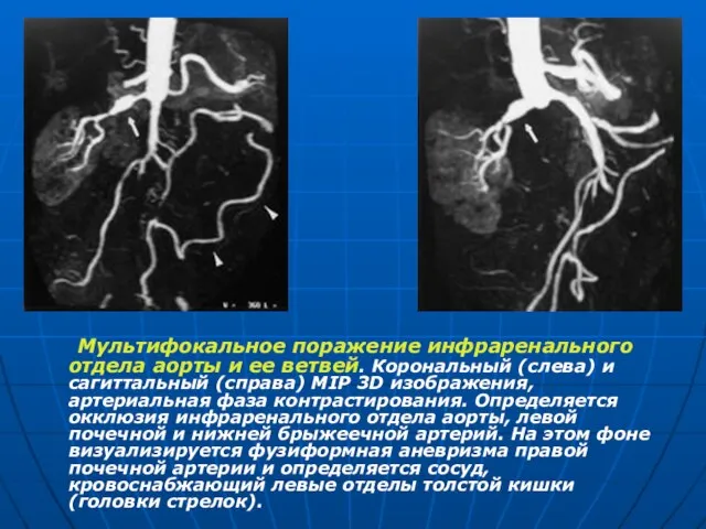 Мультифокальное поражение инфраренального отдела аорты и ее ветвей. Корональный (слева) и