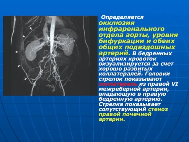 Определяется окклюзия инфраренального отдела аорты, уровня бифуркации и обеих общих подвздошных