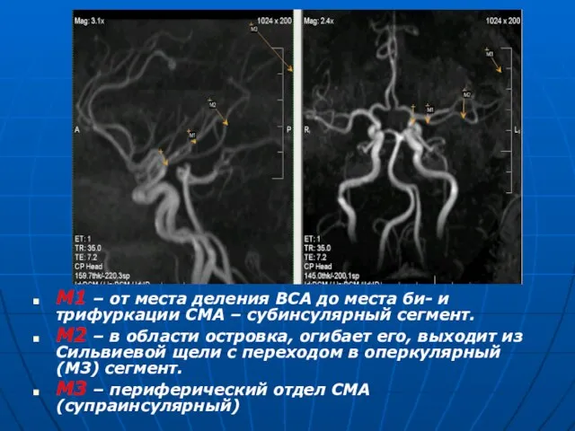 М1 – от места деления ВСА до места би- и трифуркации