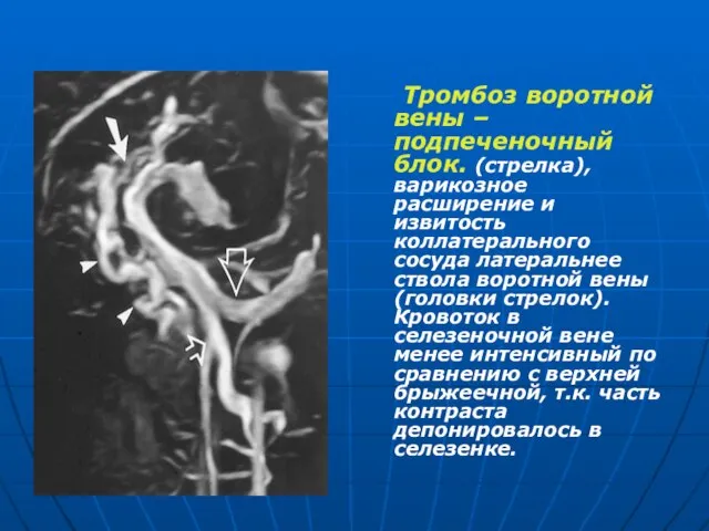 Тромбоз воротной вены –подпеченочный блок. (стрелка), варикозное расширение и извитость коллатерального