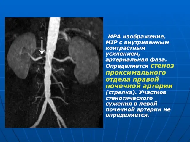 МРА изображение, MIP с внутривенным контрастным усилением, артериальная фаза. Определяется стеноз