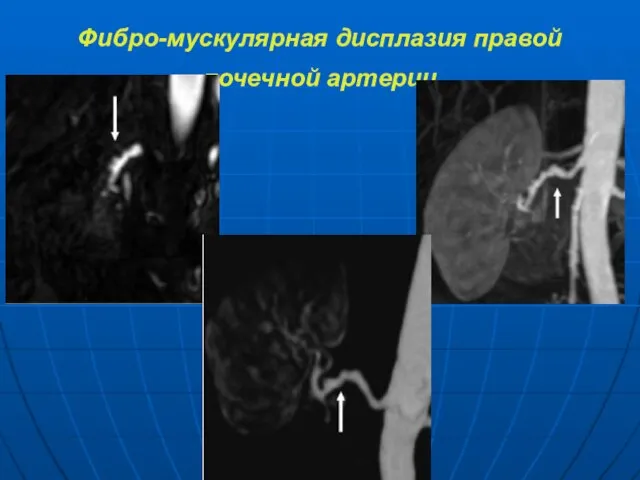 Фибро-мускулярная дисплазия правой почечной артерии