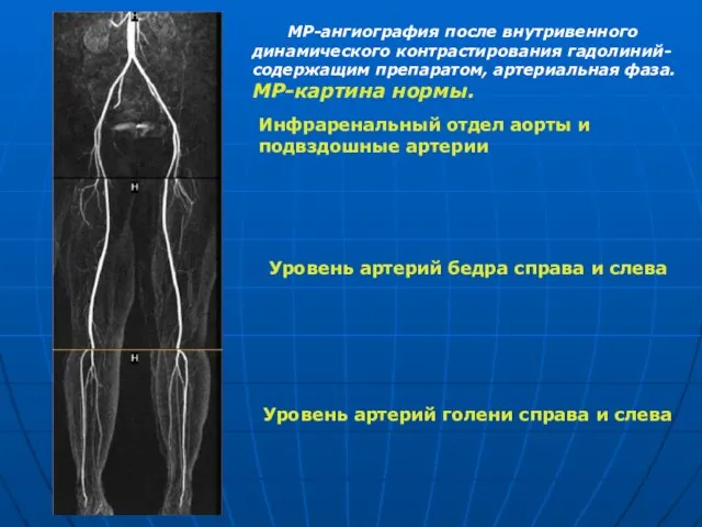 МР-ангиография после внутривенного динамического контрастирования гадолиний-содержащим препаратом, артериальная фаза. МР-картина нормы.