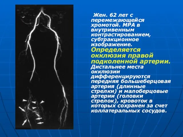 Жен. 62 лет с перемежающейся хромотой. МРА в внутривенным контрастированием, субтракционное