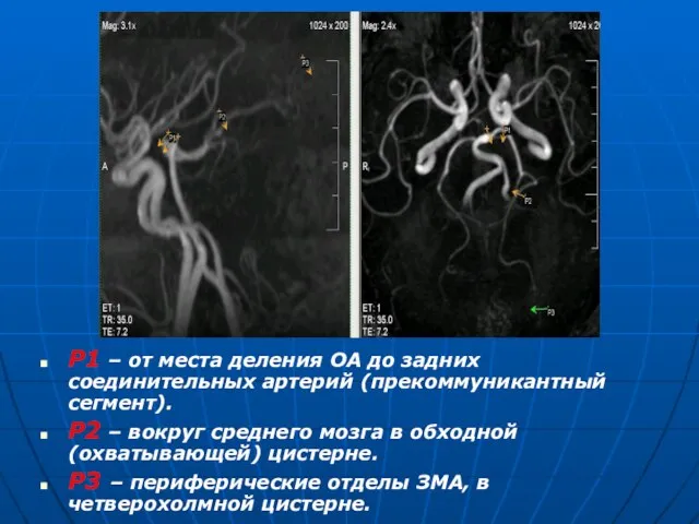 Р1 – от места деления ОА до задних соединительных артерий (прекоммуникантный