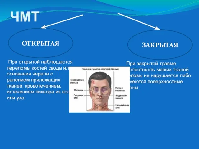 ЧМТ ЗАКРЫТАЯ ОТКРЫТАЯ При закрытой травме целостность мягких тканей головы не