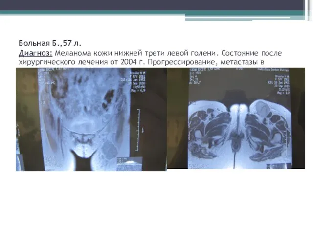 Больная Б.,57 л. Диагноз: Меланома кожи нижней трети левой голени. Состояние