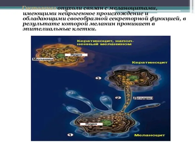 Гистогенез опухоли связан с меланоцитами, имеющими нейрогенное происхождение и обладающими своеобразной