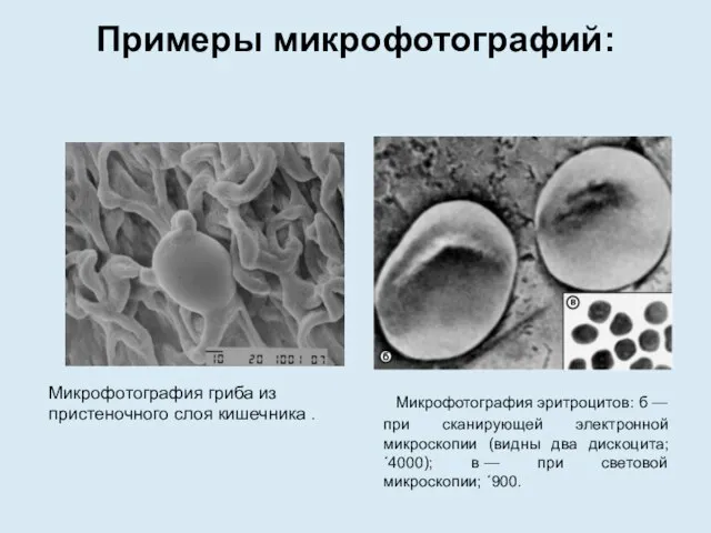 Примеры микрофотографий: Микрофотография эритроцитов: б — при сканирующей электронной микроскопии (видны