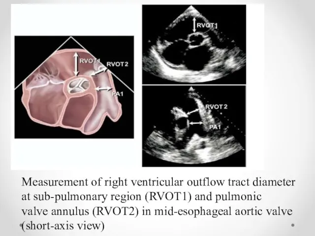 Measurement of right ventricular outflow tract diameter at sub-pulmonary region (RVOT1)