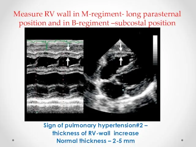 Measure RV wall in M-regiment- long parasternal position and in B-regiment