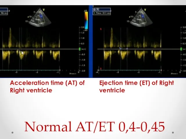 Acceleration time (AT) of Right ventricle Ejection time (ET) of Right ventricle Normal AT/ET 0,4-0,45