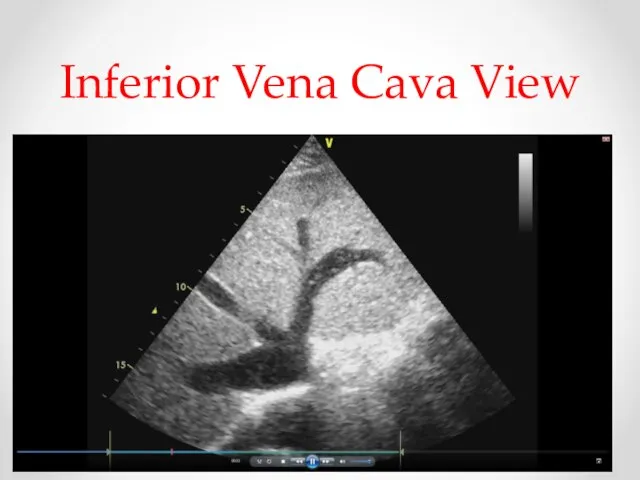 Inferior Vena Cava View