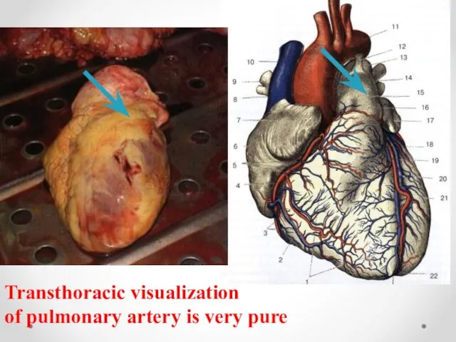 c Transthoracic visualization of pulmonary artery is very pure